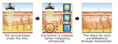 U-Lipolysis Process
